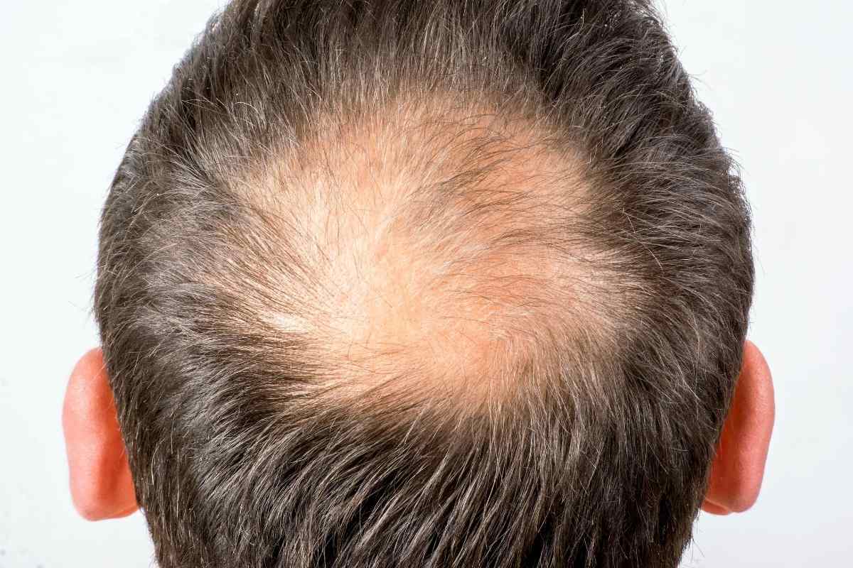 queda de cabelo masculino causas da queda de cabelo