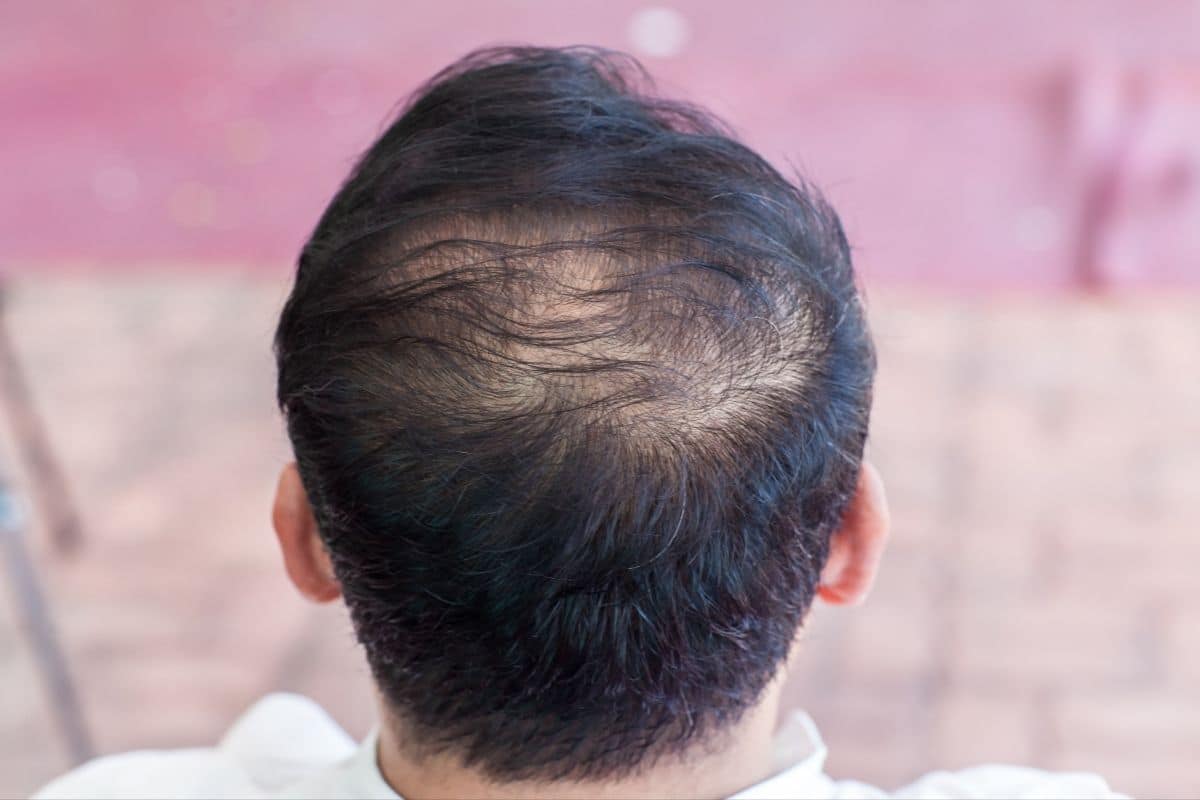 queda capilar queda capilar o que fazer perda de cabelo queda de cabelo tratamento para queda de cabelo